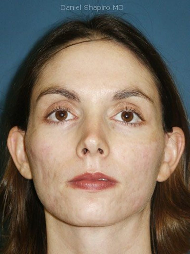 Laser Resurfacing Before & After Gallery - Patient 17363011 - Image 2