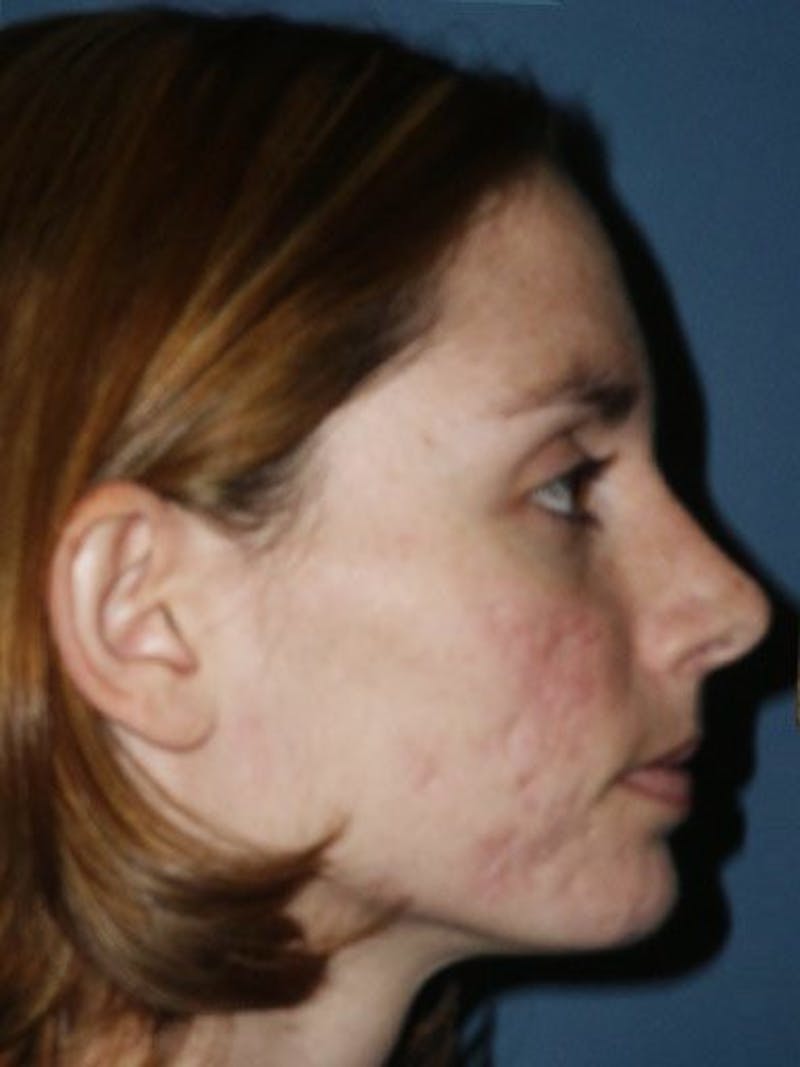 Laser Resurfacing Before & After Gallery - Patient 17363011 - Image 3