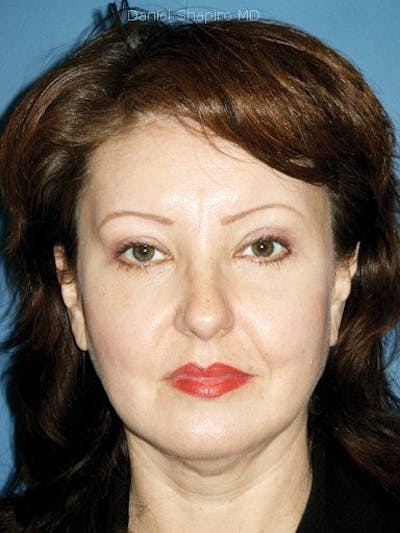 Eyes Before & After Gallery - Patient 17363012 - Image 2
