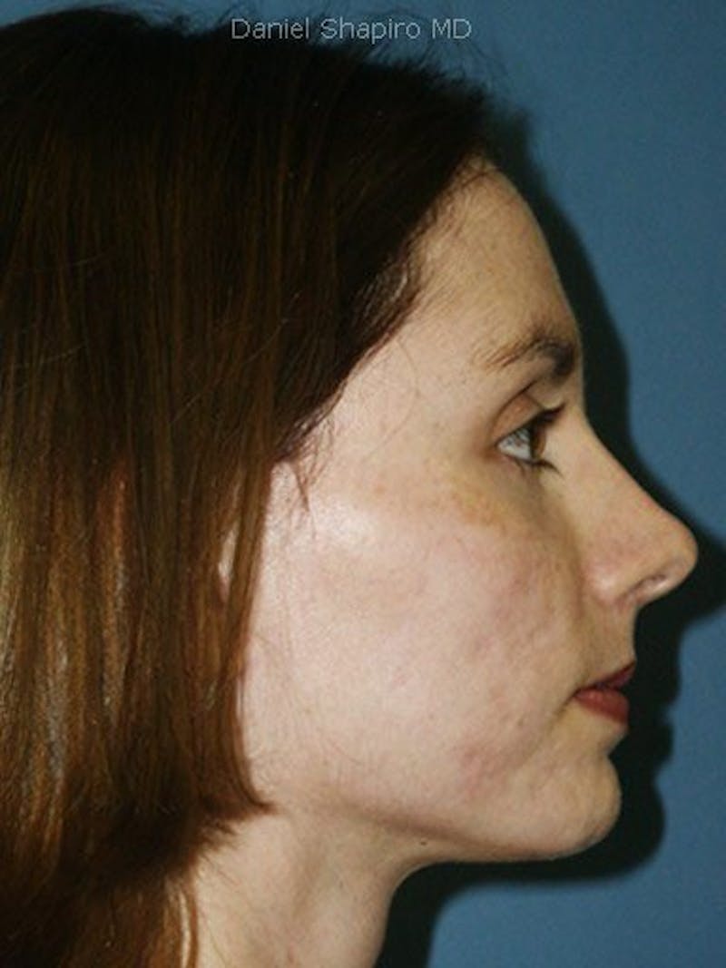 Laser Resurfacing Before & After Gallery - Patient 17363011 - Image 4