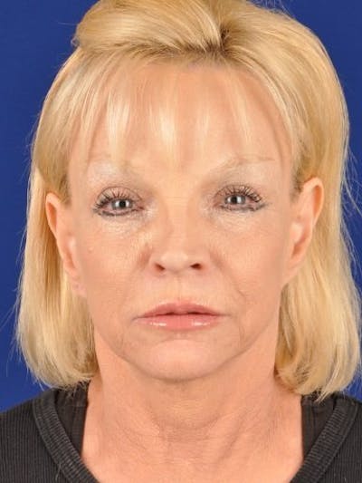 Fat Transfer Face Before & After Gallery - Patient 17363013 - Image 1