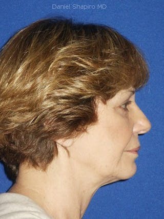 Eyes Before & After Gallery - Patient 17363014 - Image 4
