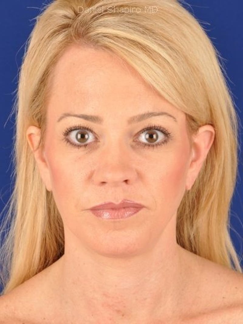 Fat Transfer Face Before & After Gallery - Patient 17363015 - Image 2