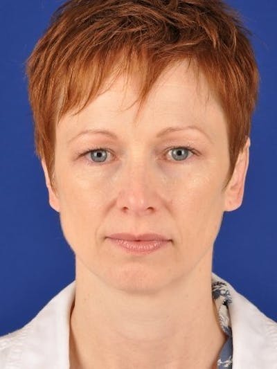 Fat Transfer Face Before & After Gallery - Patient 17363019 - Image 1