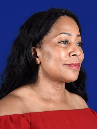 InMode FaceTite Before & After Gallery - Patient 17363021 - Image 4