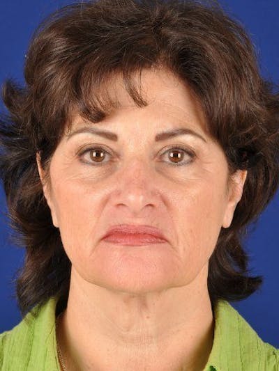 Fat Transfer Face Before & After Gallery - Patient 17363022 - Image 1