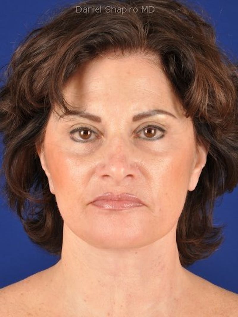 Fat Transfer Face Before & After Gallery - Patient 17363022 - Image 2