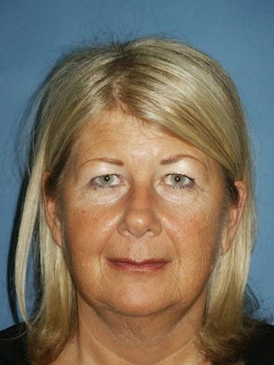 Eyes Before & After Gallery - Patient 17363023 - Image 1