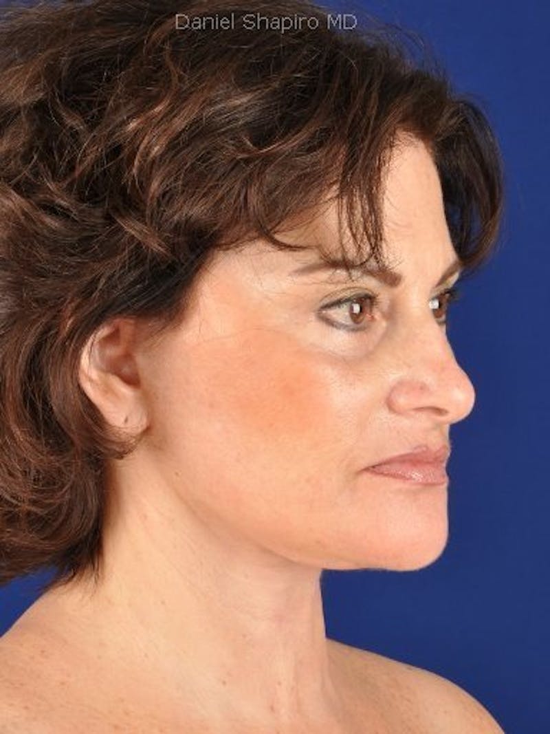 Fat Transfer Face Before & After Gallery - Patient 17363022 - Image 4