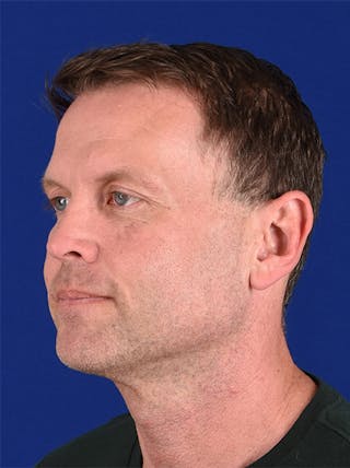 InMode FaceTite Before & After Gallery - Patient 17363026 - Image 4