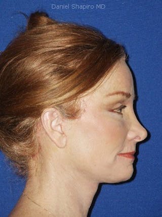 Eyes Before & After Gallery - Patient 17363025 - Image 4