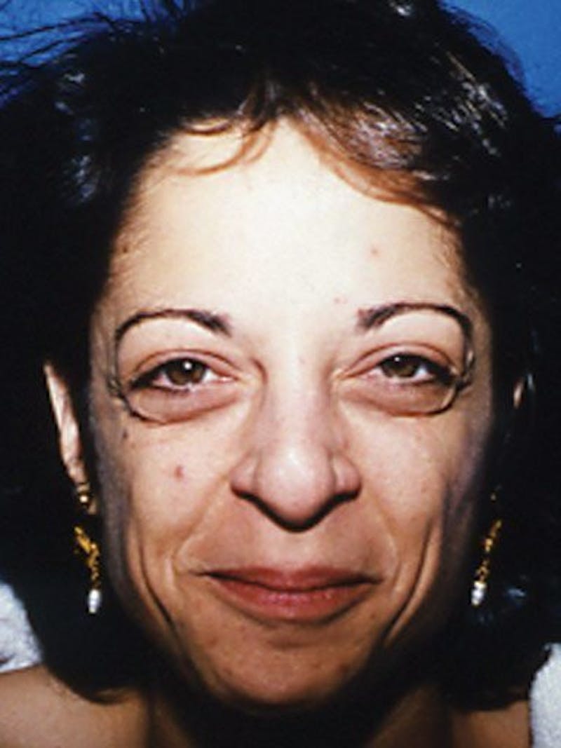 Eyes Before & After Gallery - Patient 17363027 - Image 1