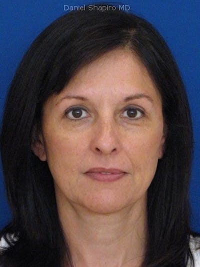 Eyes Before & After Gallery - Patient 17363033 - Image 2