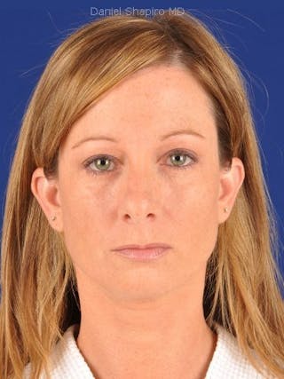 Eyes Before & After Gallery - Patient 17363702 - Image 2