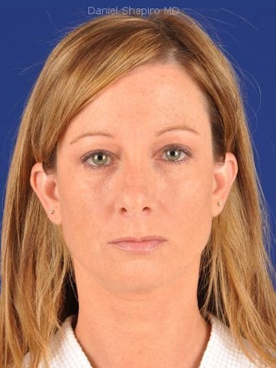 Eyes Before & After Gallery - Patient 17363702 - Image 2