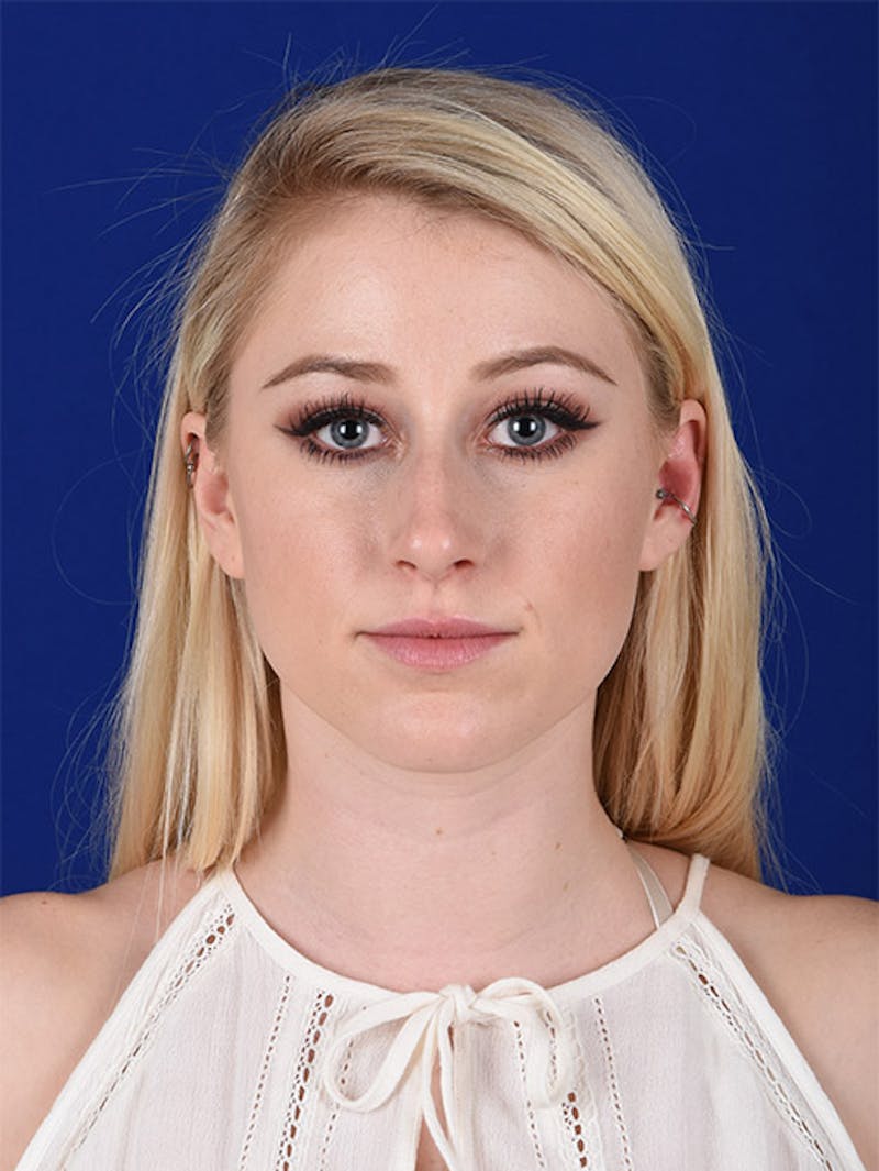 Female Rhinoplasty Before & After Gallery - Patient 17363707 - Image 1