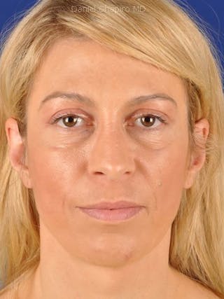 Eyes Before & After Gallery - Patient 17363709 - Image 2