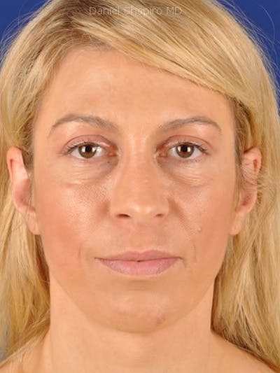 Eyes Before & After Gallery - Patient 17363709 - Image 2