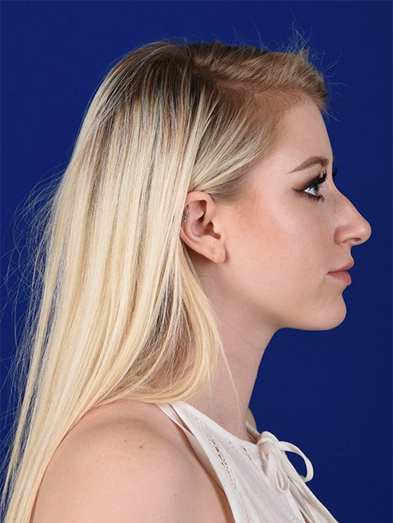 Female Rhinoplasty Before & After Gallery - Patient 17363707 - Image 5