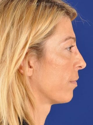 Eyes Before & After Gallery - Patient 17363709 - Image 4