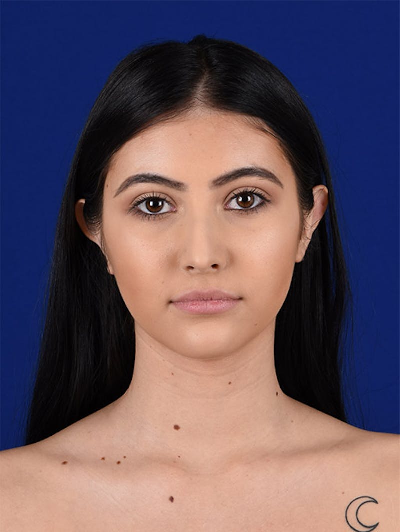 Female Rhinoplasty Before & After Gallery - Patient 17363713 - Image 1