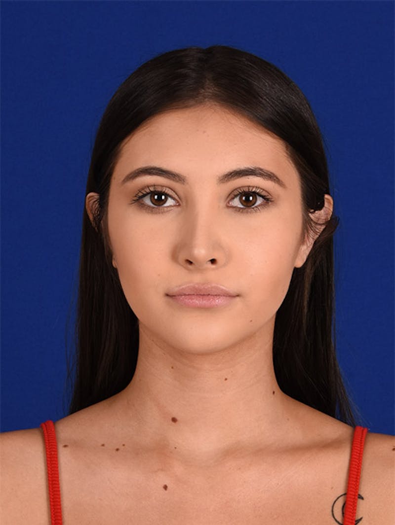 Female Rhinoplasty Before & After Gallery - Patient 17363713 - Image 2