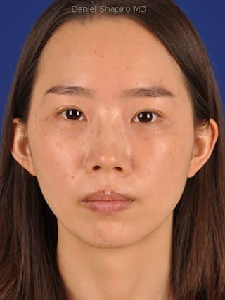 Eyes Before & After Gallery - Patient 17363711 - Image 2