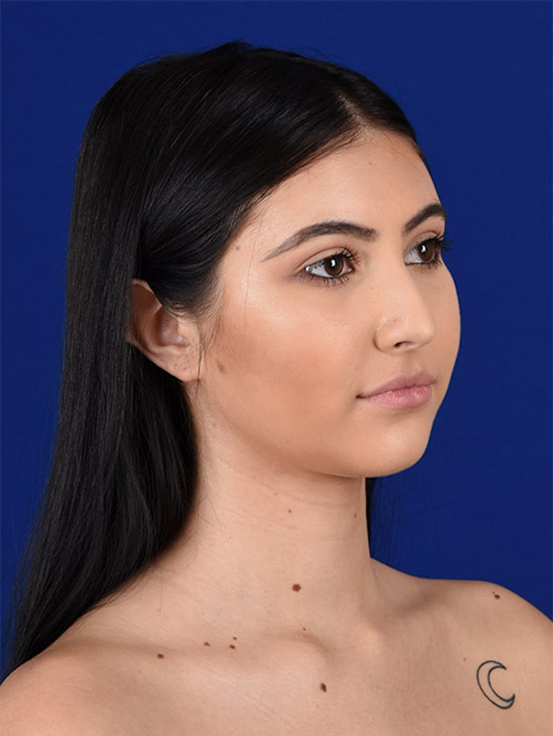 Female Rhinoplasty Before & After Gallery - Patient 17363713 - Image 3