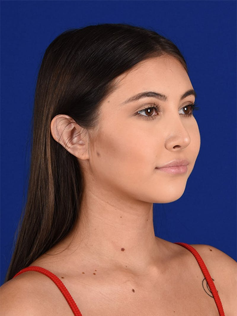 Female Rhinoplasty Before & After Gallery - Patient 17363713 - Image 4