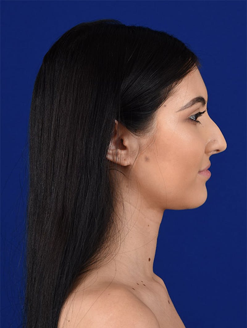 Female Rhinoplasty Before & After Gallery - Patient 17363713 - Image 5