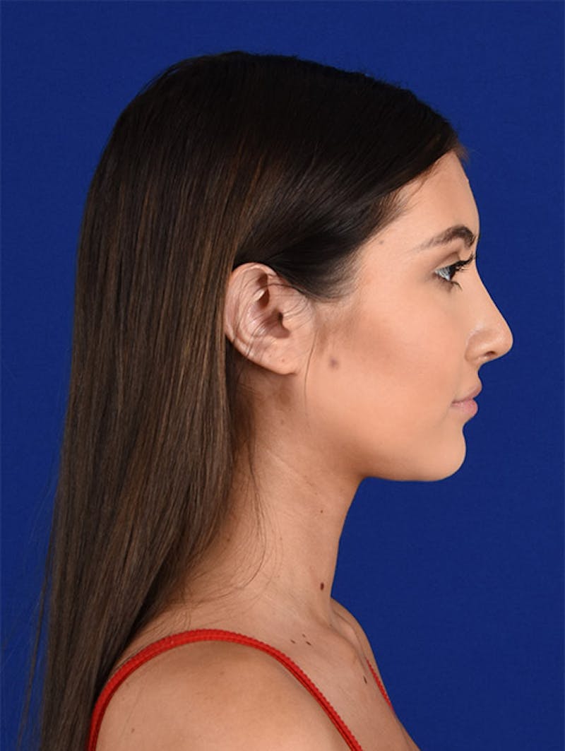 Female Rhinoplasty Before & After Gallery - Patient 17363713 - Image 6