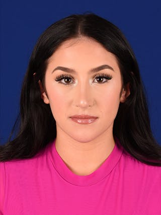 Female Rhinoplasty Before & After Gallery - Patient 17363723 - Image 2