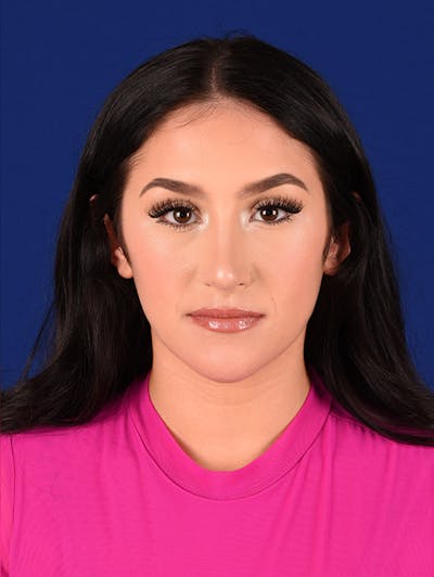 Female Rhinoplasty Before & After Gallery - Patient 17363723 - Image 2