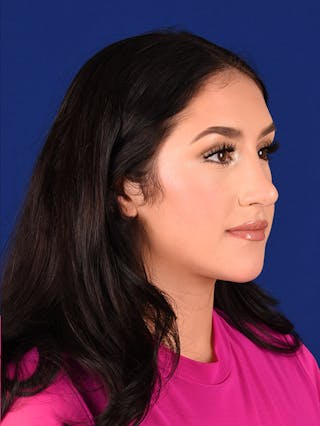 Female Rhinoplasty Before & After Gallery - Patient 17363723 - Image 4
