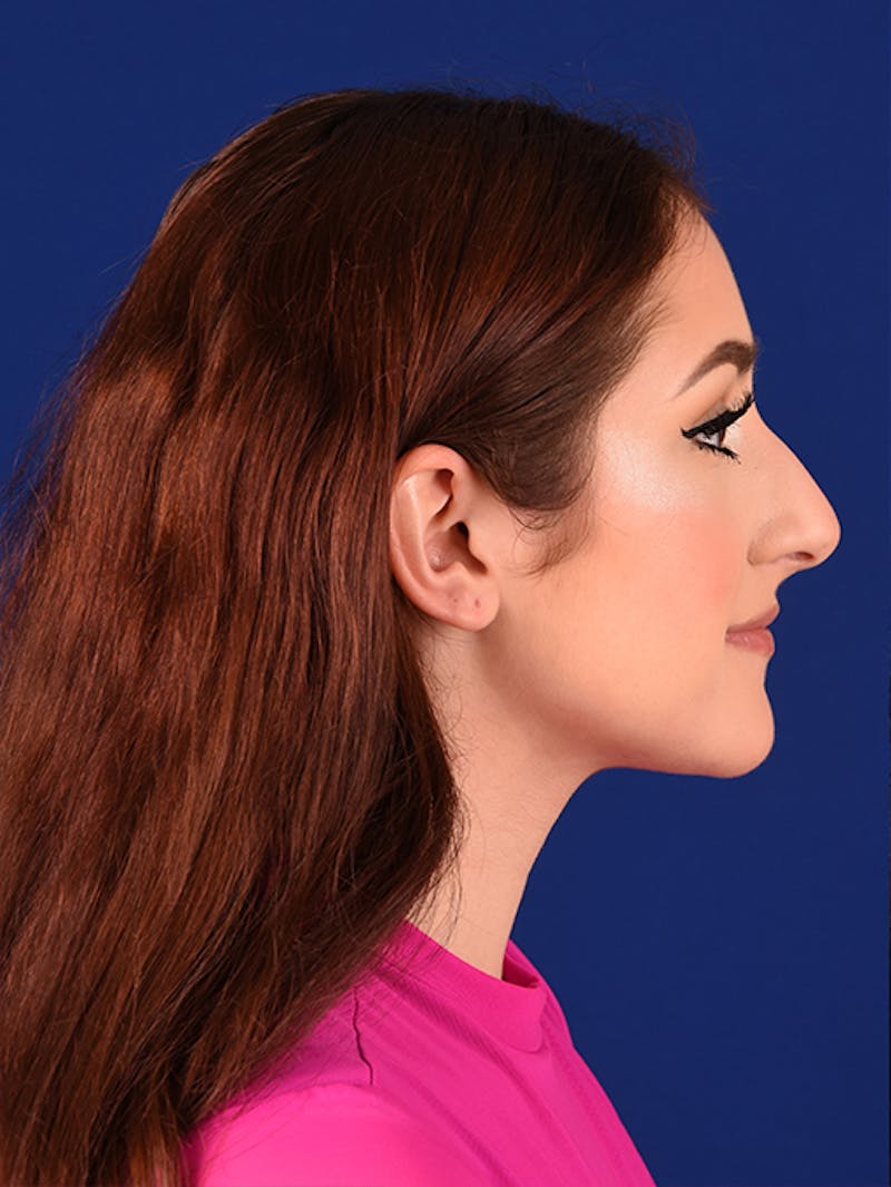 Female Rhinoplasty Before & After Gallery - Patient 17363723 - Image 5