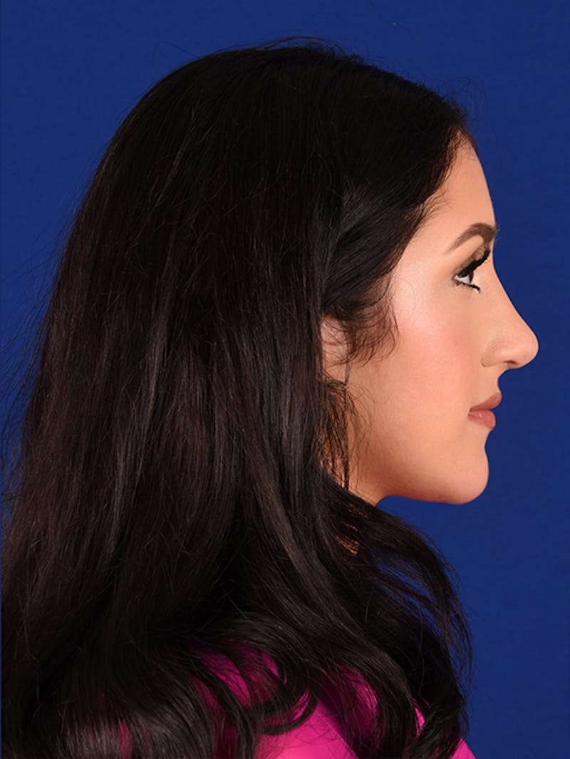 Female Rhinoplasty Before & After Gallery - Patient 17363723 - Image 6