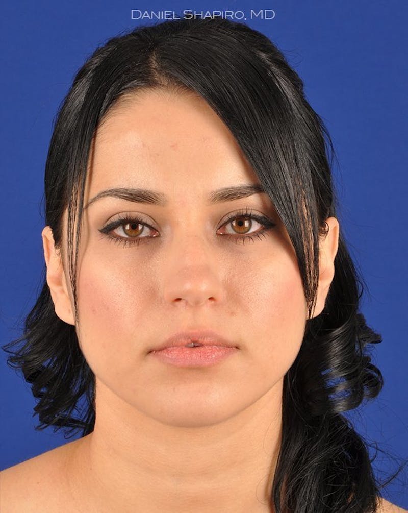 Female Rhinoplasty Before & After Gallery - Patient 17363724 - Image 1