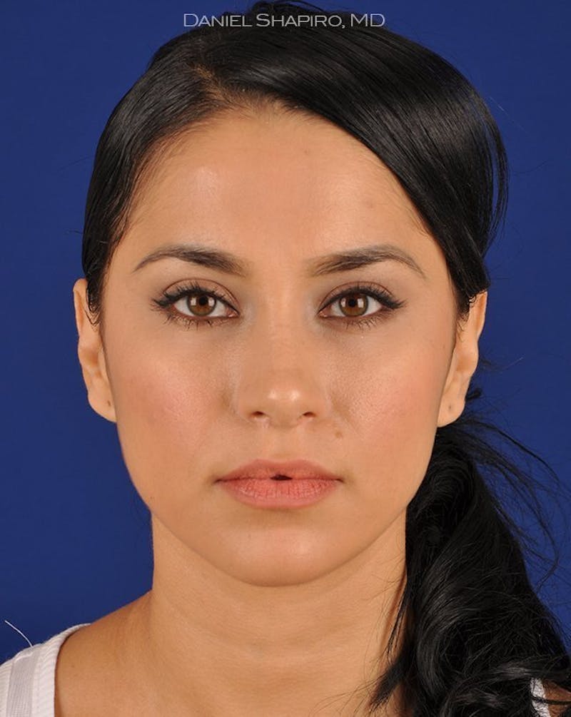 Female Rhinoplasty Before & After Gallery - Patient 17363724 - Image 2