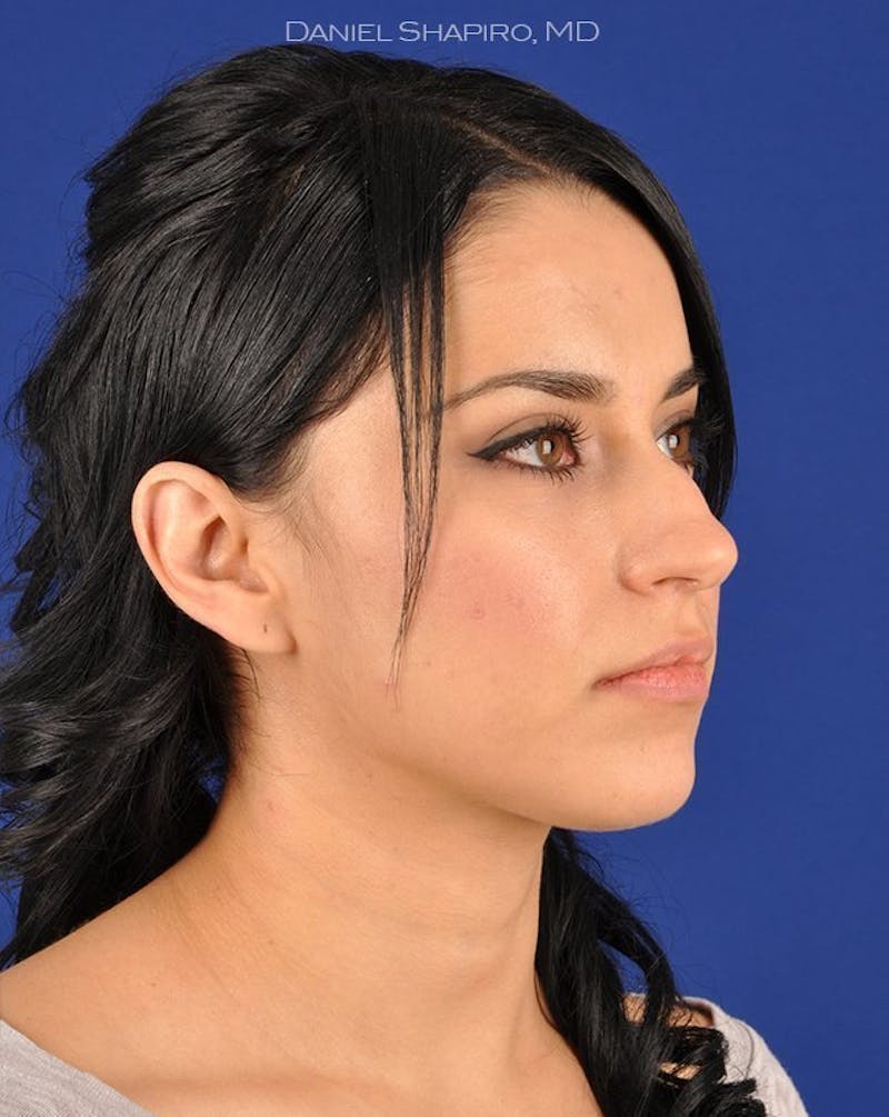 Female Rhinoplasty Before & After Gallery - Patient 17363724 - Image 3