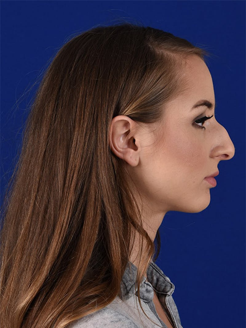 Female Rhinoplasty Before & After Gallery - Patient 17363728 - Image 5