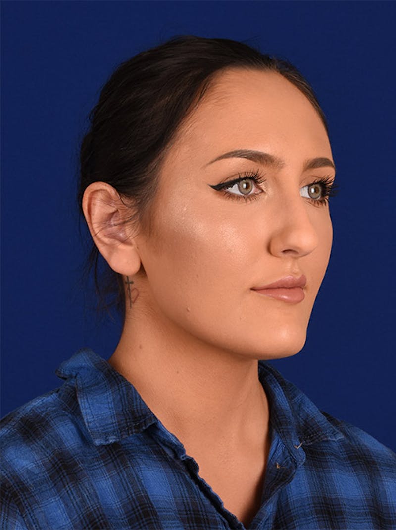 Female Rhinoplasty Before & After Gallery - Patient 17363730 - Image 3
