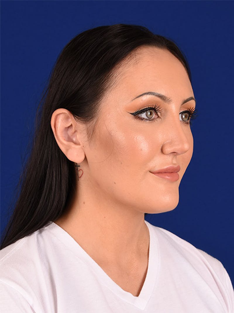 Female Rhinoplasty Before & After Gallery - Patient 17363730 - Image 4