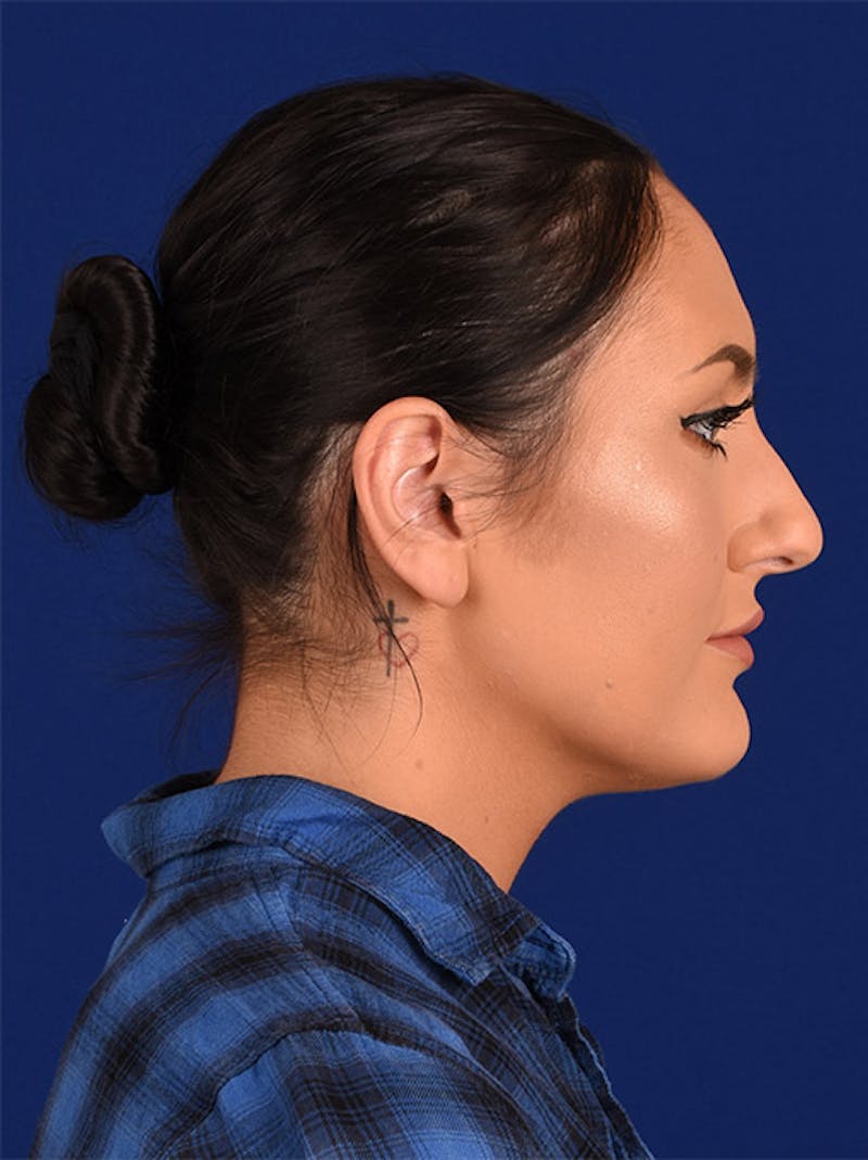 Female Rhinoplasty Before & After Gallery - Patient 17363730 - Image 5