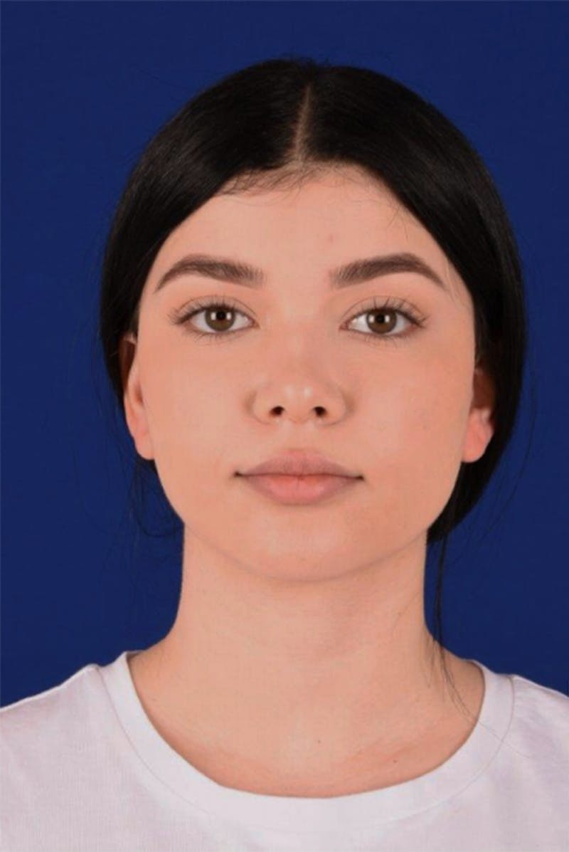 Female Rhinoplasty Before & After Gallery - Patient 17363733 - Image 1