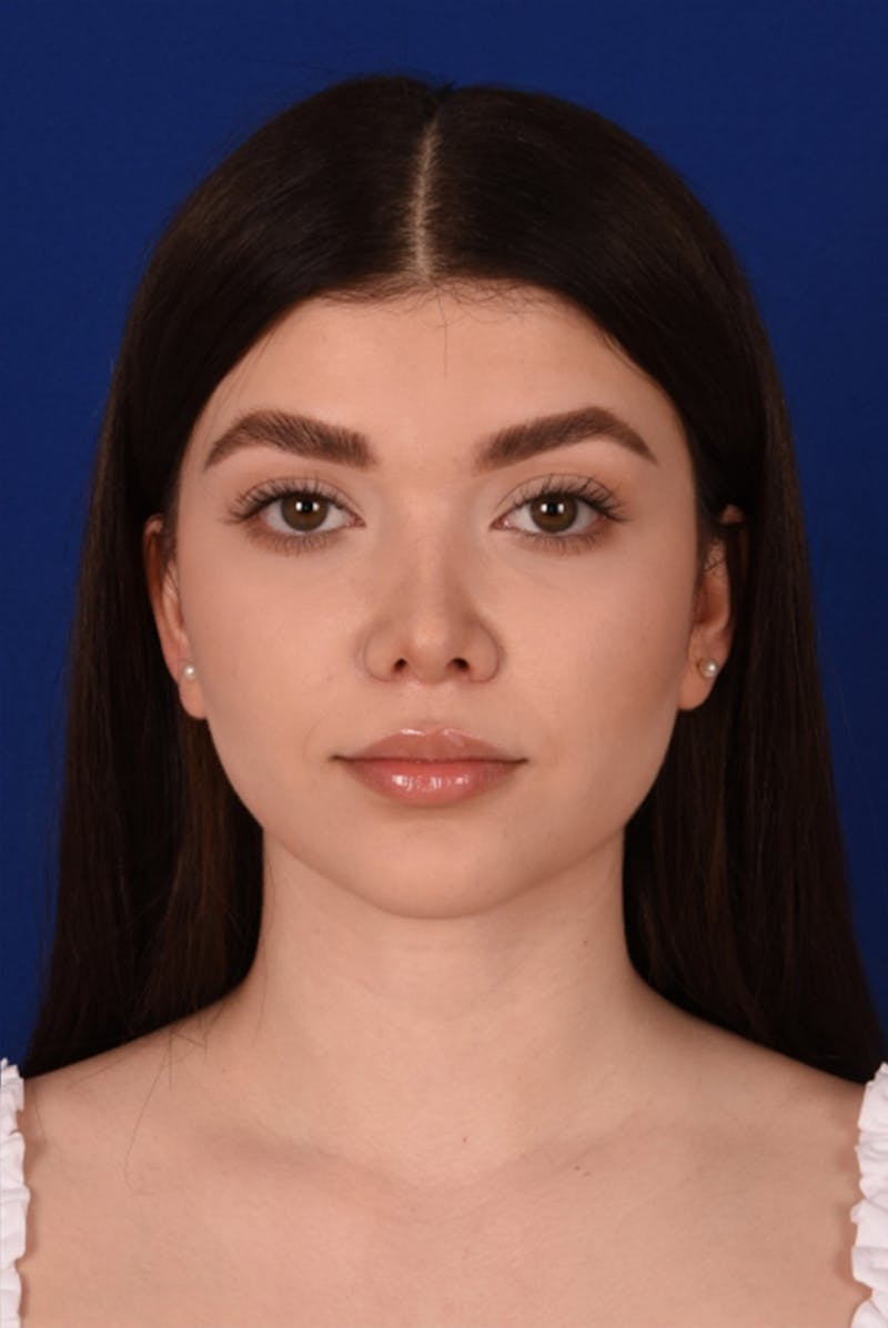 Female Rhinoplasty Before & After Gallery - Patient 17363733 - Image 2