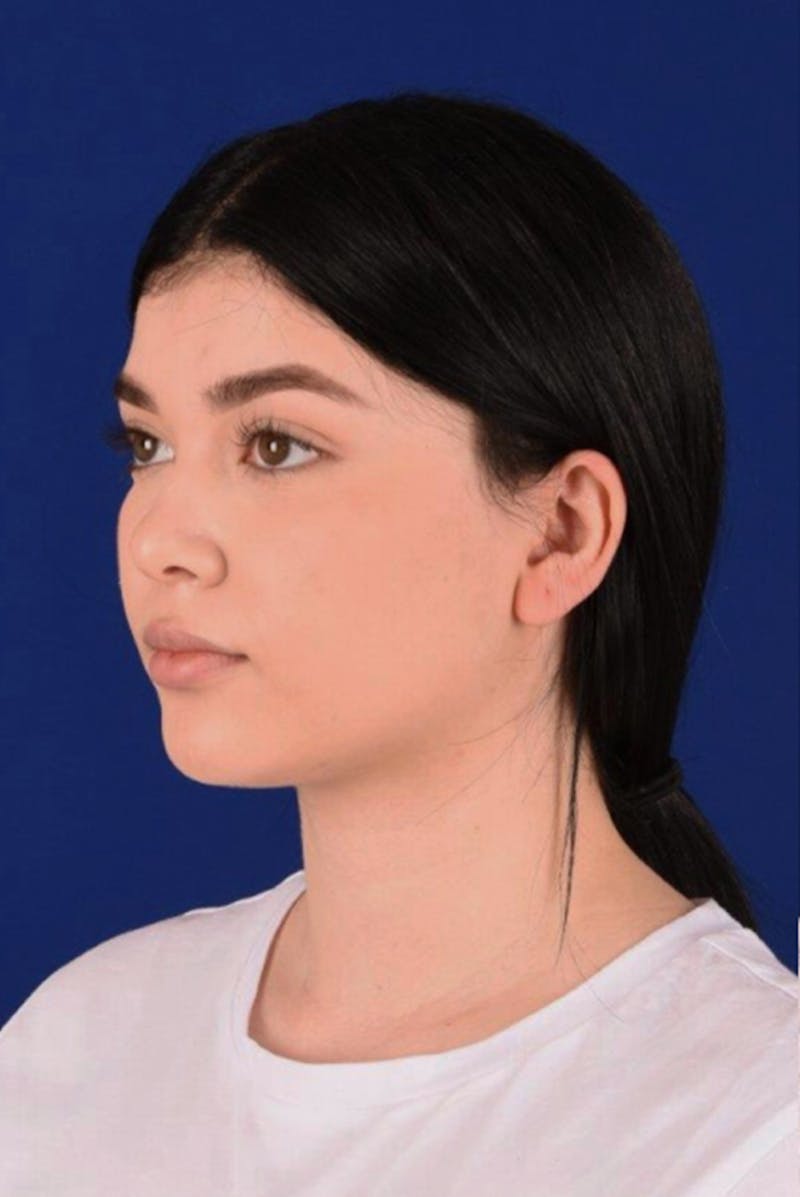 Female Rhinoplasty Before & After Gallery - Patient 17363733 - Image 3