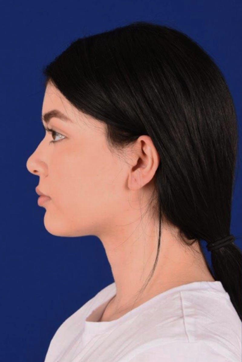 Female Rhinoplasty Before & After Gallery - Patient 17363733 - Image 5