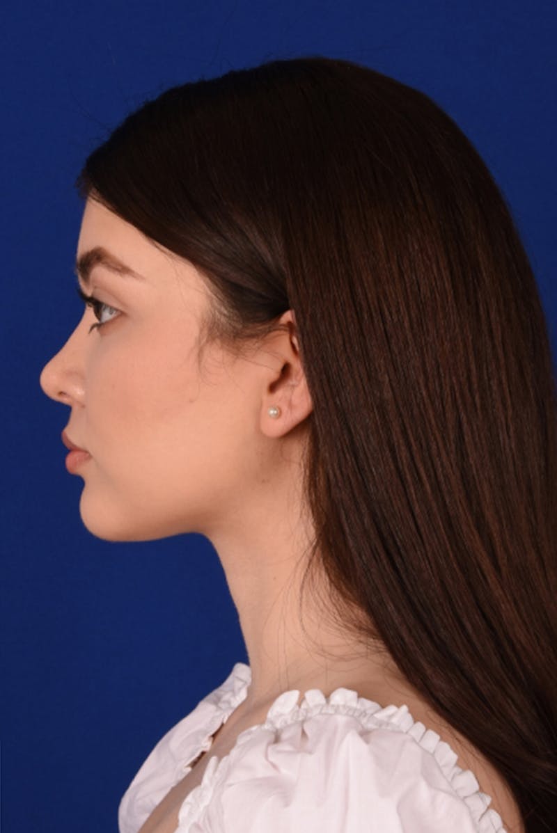 Female Rhinoplasty Before & After Gallery - Patient 17363733 - Image 6