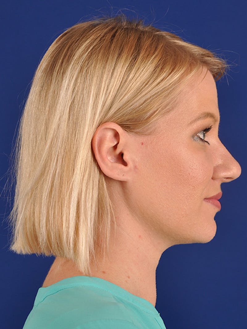 Female Rhinoplasty Before & After Gallery - Patient 17363736 - Image 5