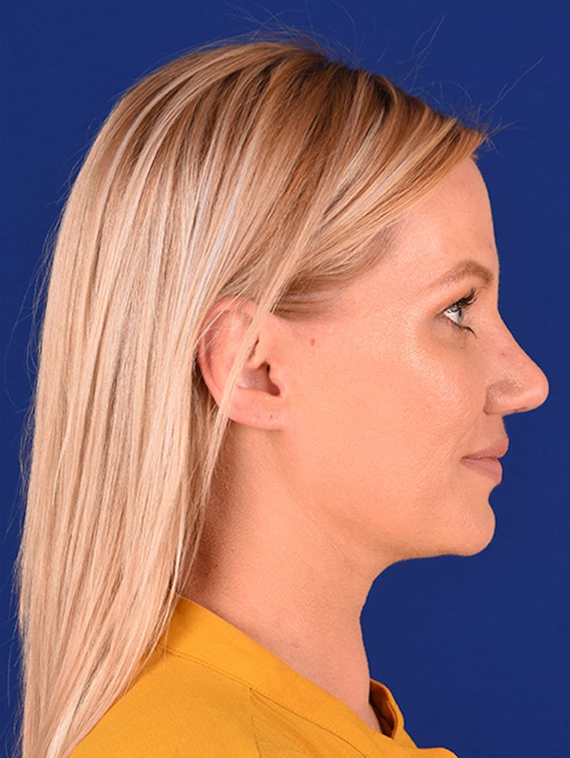 Female Rhinoplasty Before & After Gallery - Patient 17363736 - Image 6
